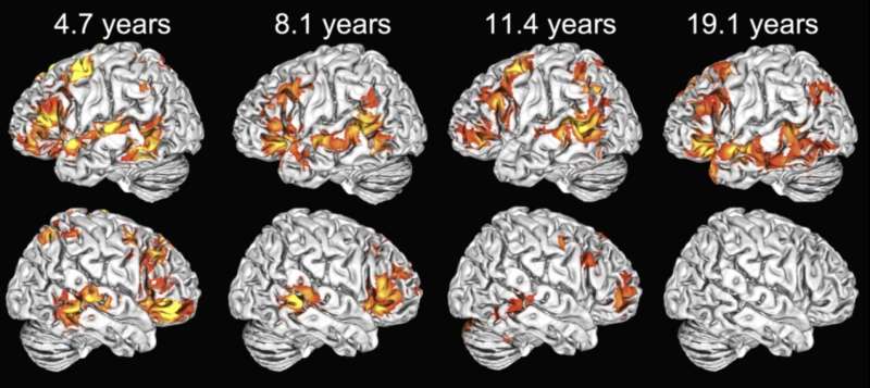Children use both brain hemispheres to understand language, unlike adults