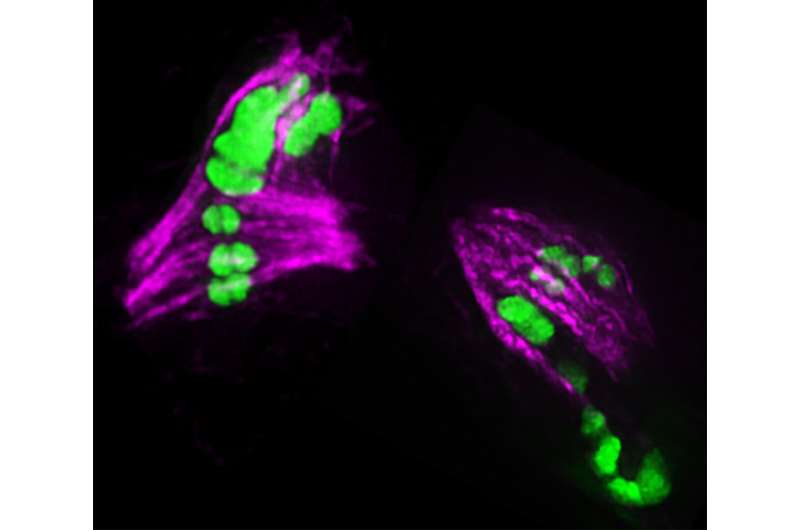Chromosome defects seen from over-exchange of DNA in sperm and eggs