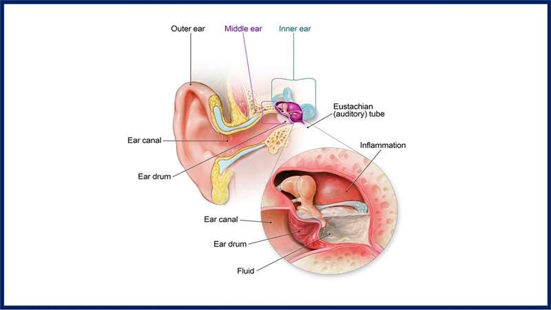 Clinicians use artificial intelligence to diagnose ear infections more accurately