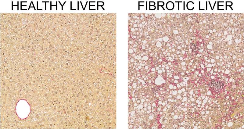 Closing in on liver fibrosis: Detailing the fibrosis process at unprecedented resolution