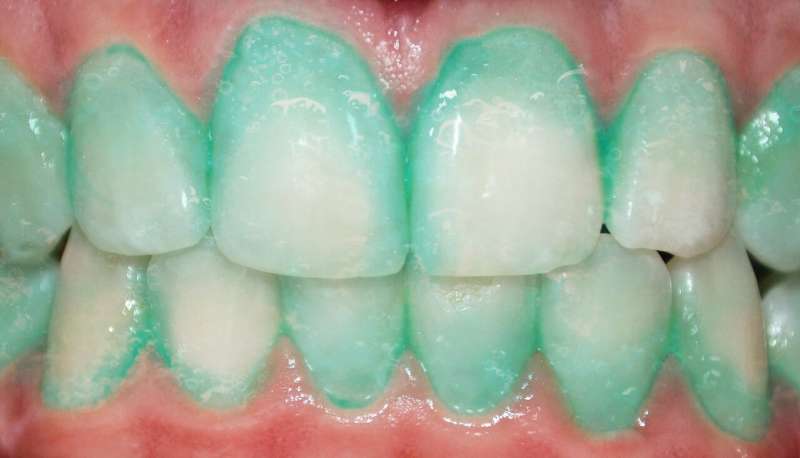 Could this plaque identifying toothpaste prevent a heart attack or stroke?