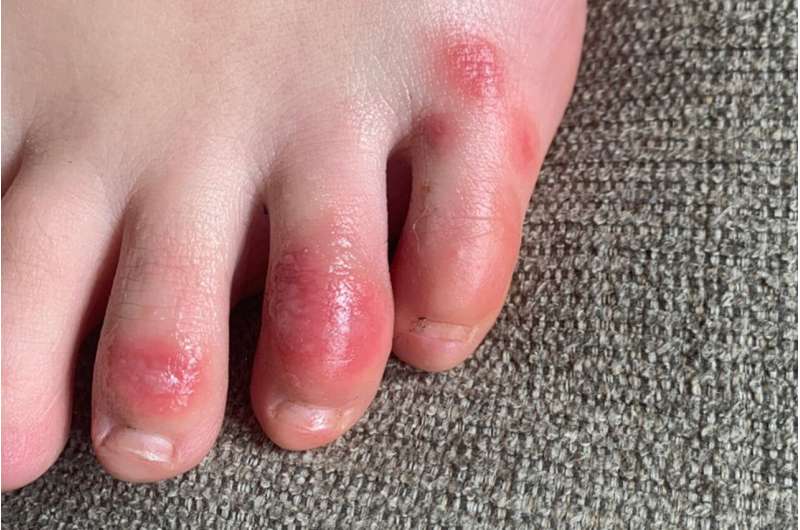'COVID toes,' other rashes latest possible rare virus signs