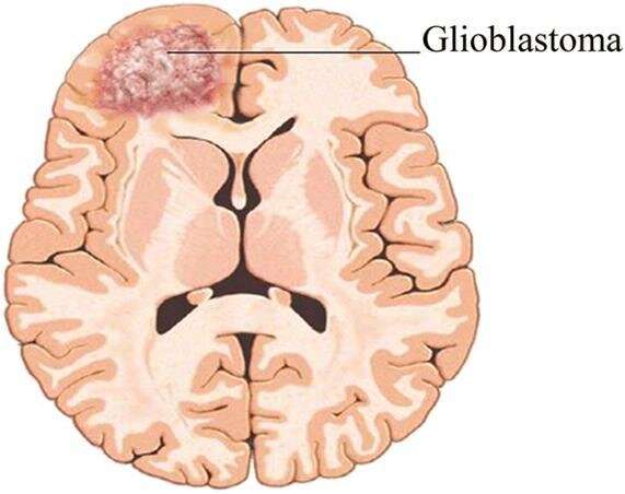Deep Belief Networks Detect Glioblastoma Tumor