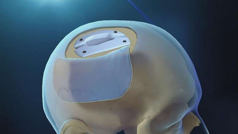 Device safely treats brain swelling 'undercover'
