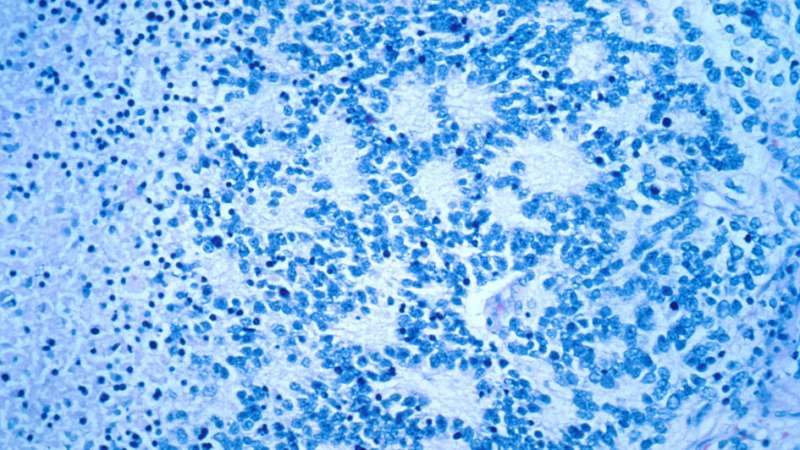 Drug used in breast and ovarian cancer could lead to safer, more effective treatment for neuroblastoma