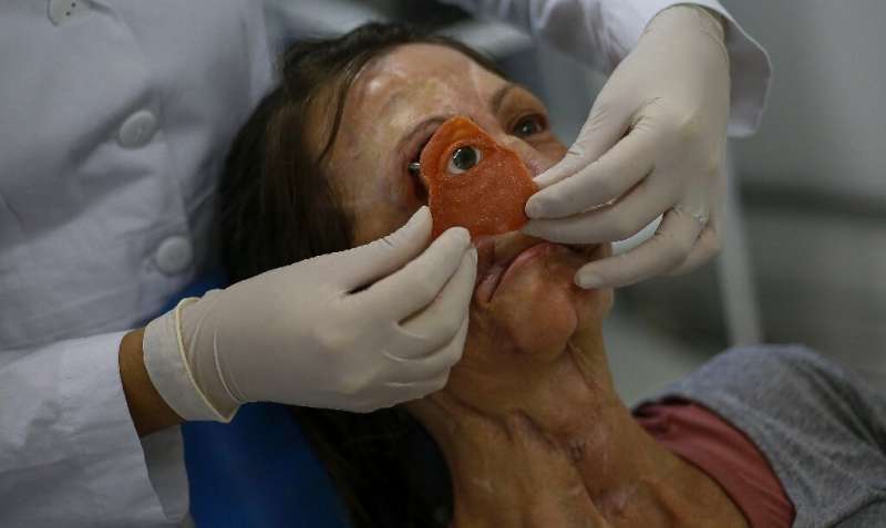 Fitting the facial prosthesis is a meticulous process