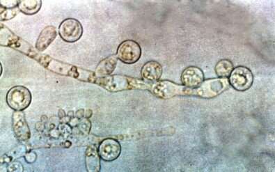 Genetically similar fungi cause severe infections in different hospitals