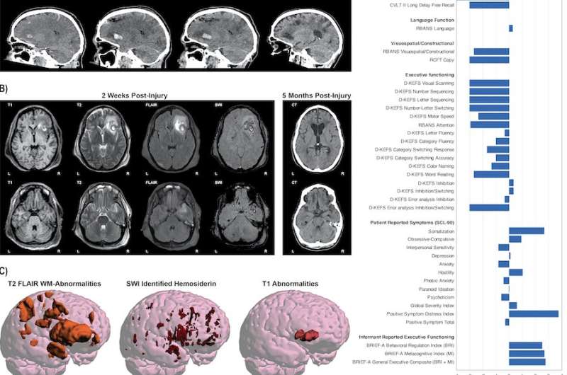 Global MRI data offers hope for improving treatment of brain injuries