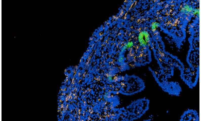 肠道研究识别关键细胞变化与儿童相关的克罗恩病