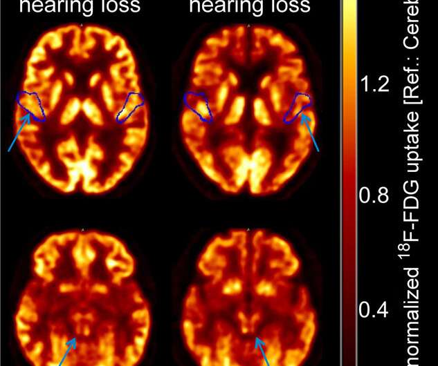 High-resolution PET/CT assesses brain stem function in patients with hearing impairment
