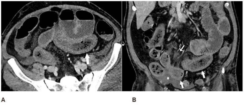 Imaging reveals bowel abnormalities in patients with COVID-19