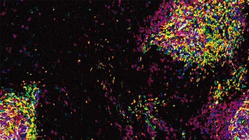 Immune cells hampered when fighting soft tissue and bone sarcomas