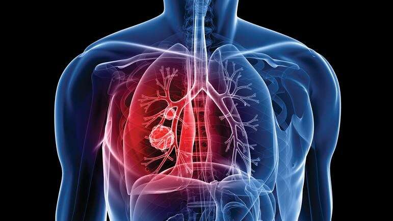 Improvements in lung cancer care