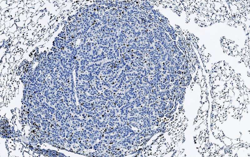Inhibition of p38 reduces the growth of lung tumours