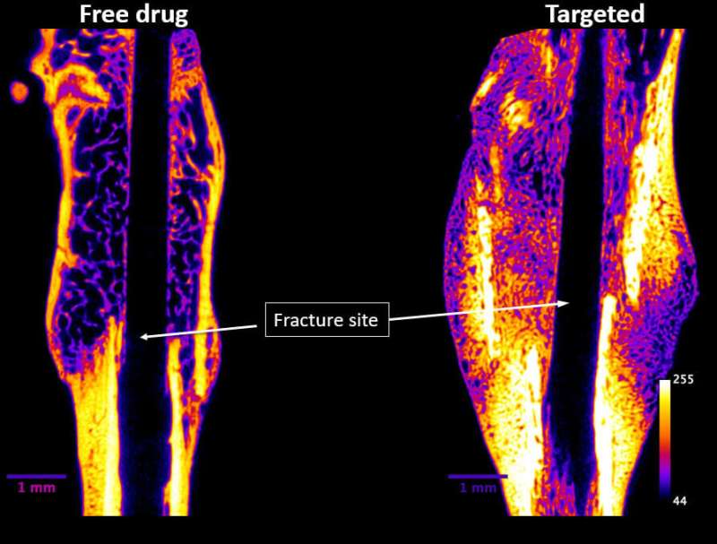 Injectable drug for faster healing of bone fractures prepares for clinical trials