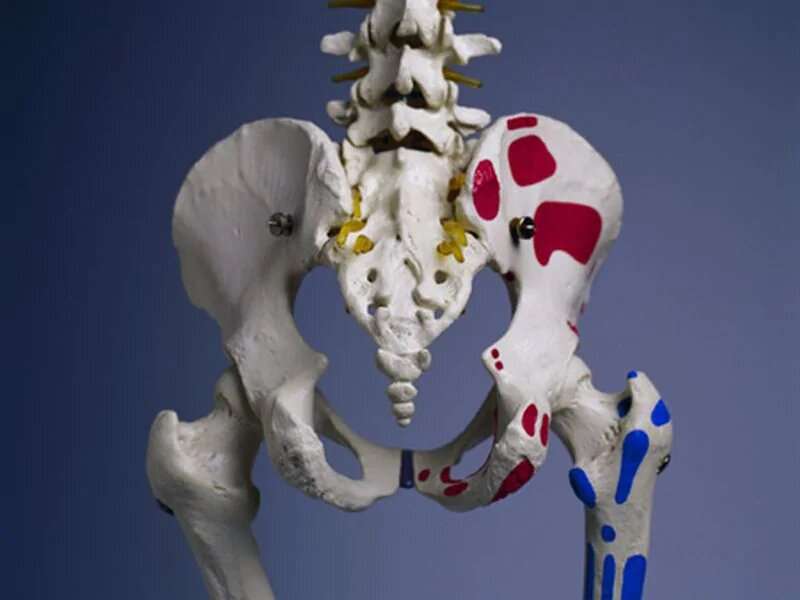 In many cases, hip replacement also eases back pain