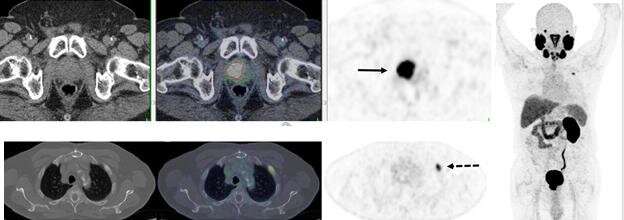 In recurrent prostate cancer, PSMA PET/CT changes management in two-thirds of cases