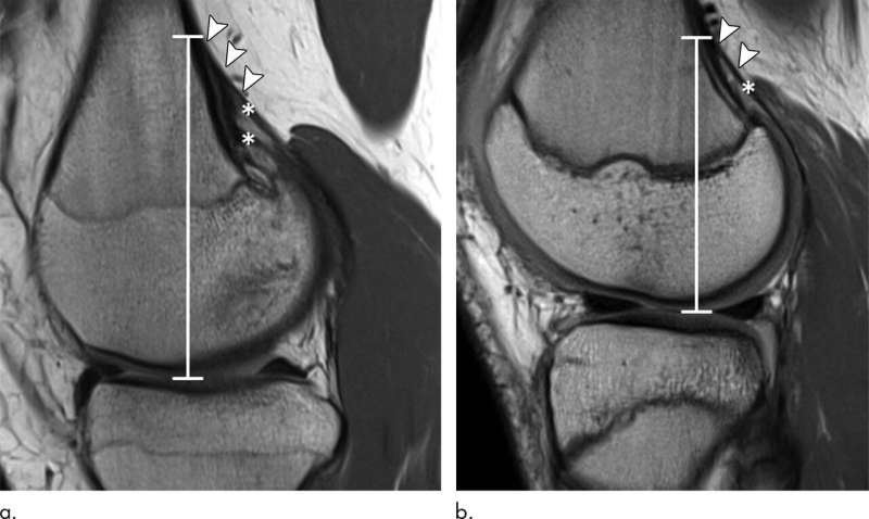 Irregular findings common in knees of young competitive alpine skiers