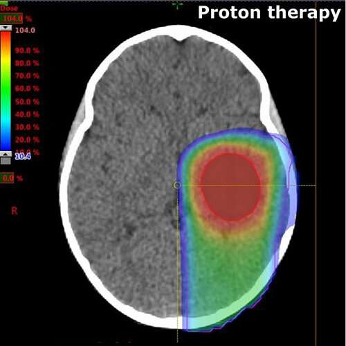 Is proton therapy the silver bullet for children with brain cancer?