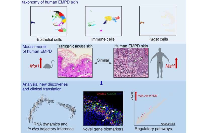 Key signaling pathway in the pathogenesis of Paget's disease identified