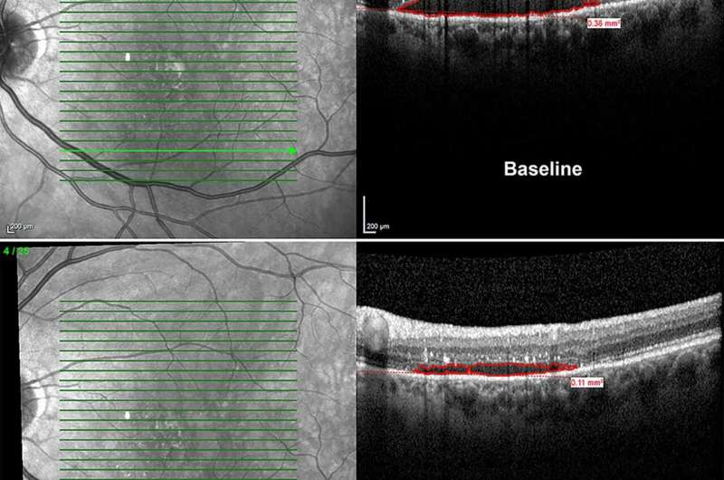 Levodopa may improve vision in patients with macular degeneration