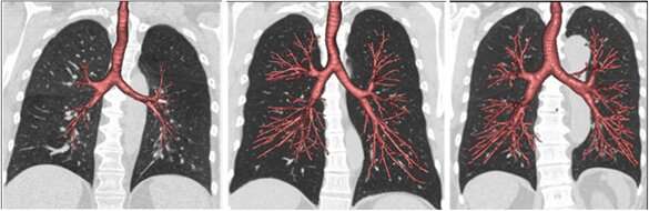Lung development may explain why some non-smokers get COPD and some heavy smokers do not