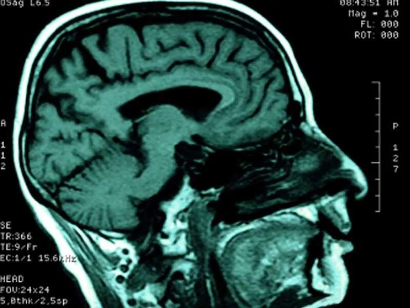 Medical management alone better for brain AV malformations