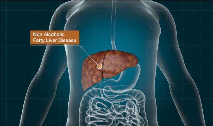 Modified Parkinson's drug shows potential in treating nonalcoholic fatty liver disease