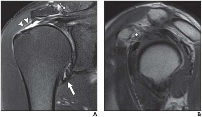 MRI findings predict shoulder stiffness for rotator cuff tears