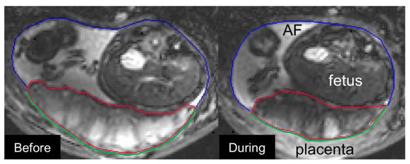 MRI pregnancy study gives new insights into the all-important placenta
