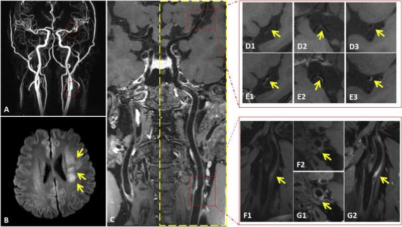 MRI Study Reveals Arterial Culprit Plaque Characteristics