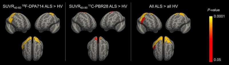 Multi-center, multi-tracer PET studies harmonized to detect neuroinflammation in ALS