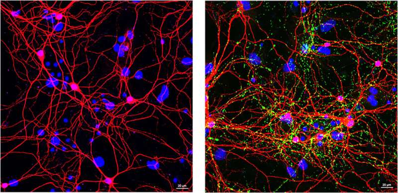 ‘Natural killer’ cells could halt Parkinson’s progression