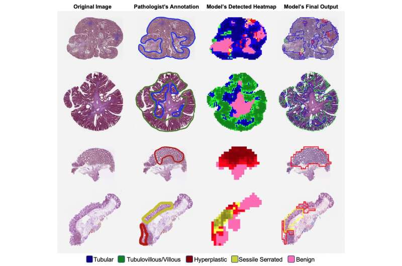 New AI model accurately classifies colorectal polyps using slides from 24 institutions