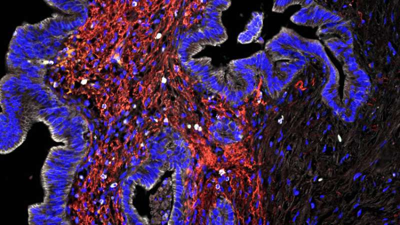 New map of the immune landscape in pancreatic cancer could guide immunotherapy