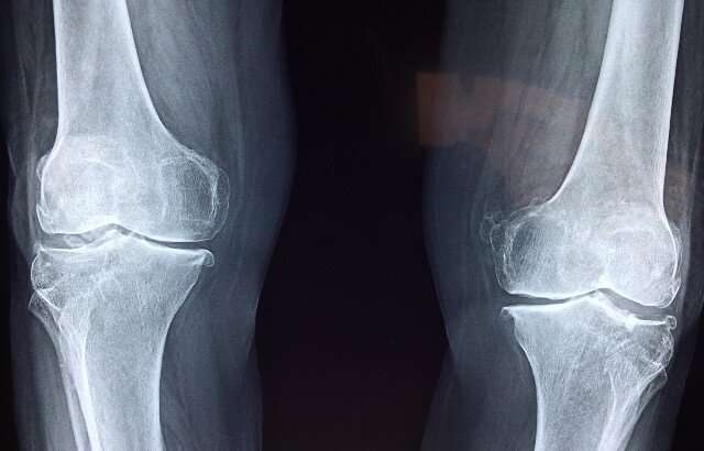 New molecule repairs cartilage and relieves symptoms of osteoarthritis