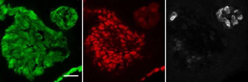 New organoids facilitate faster study of early lung cancer, potential treatments