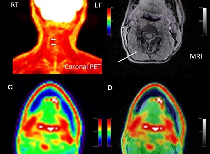 New PET/MRI approach pinpoints chronic pain location, alters management