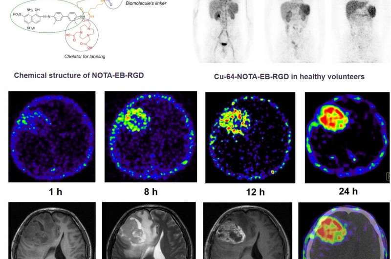 New PET radiotracer proven safe and effective in imaging malignant brain tumors