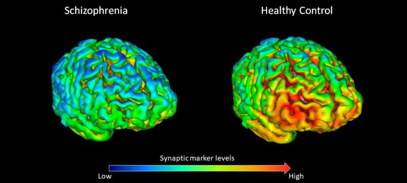 New study finds evidence for reduced brain connections in schizophrenia
