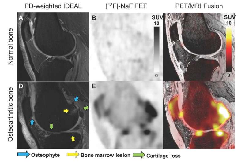 Novel bone imaging approach provides insights into the progression of knee osteoarthritis