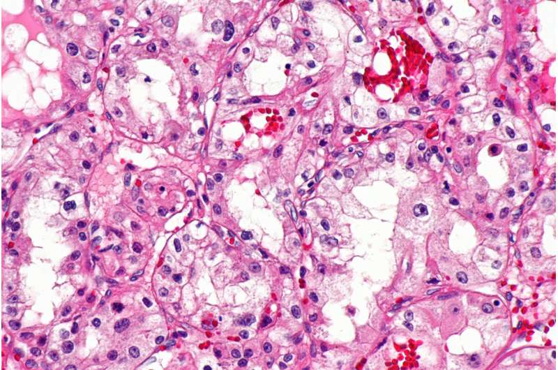Novel drug targets tumor growth in advanced kidney cancer