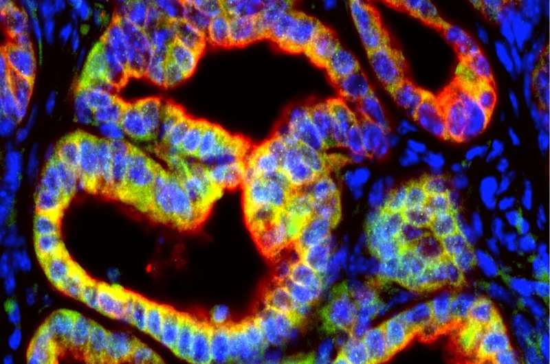Pancreatic cancer cells secrete signal that sabotages immune attack on tumors