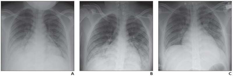 小儿冠状病毒病(COVID-19) x光,CT检查的肺部疾病