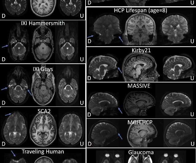 Perfecting MRI images with deep learning, Vanderbilt researchers change the way we see the brain