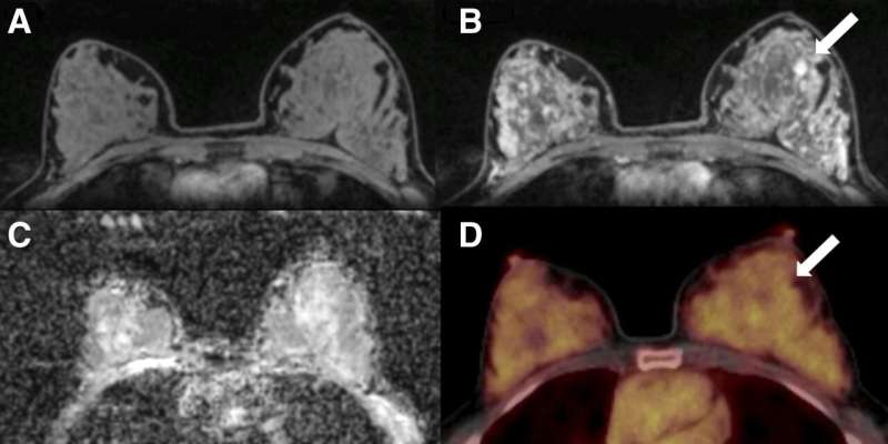 PET/MRI identifies notable breast cancer imaging biomarkers