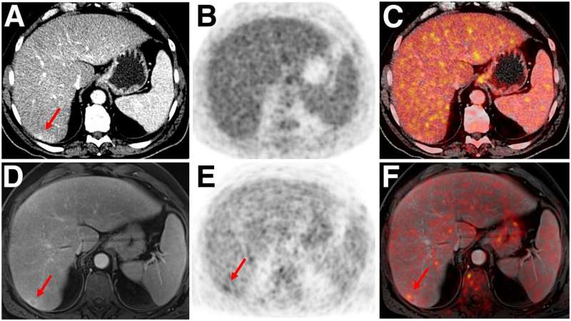 PET/MRI improves lesion detection, reduces radiation exposure