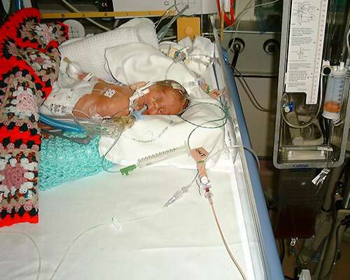 Pioneering brain haemorrhage treatment reduces long-term disability in premature babies