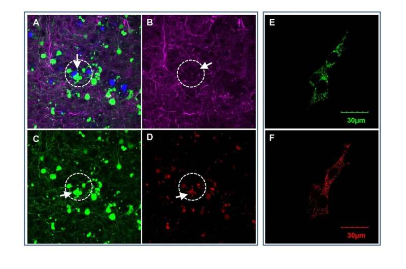 Protein associated with ovarian cancer exacerbates neurodegeneration in Alzheimer's