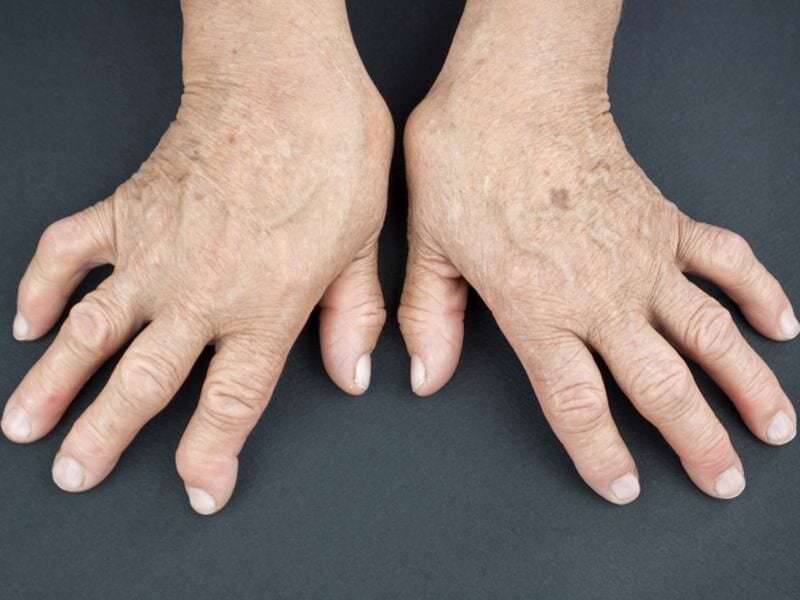 Rheumatoid arthritis patients remain unaware of CV risk